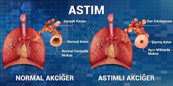 Astım ile ilgili 9 önemli bilgi