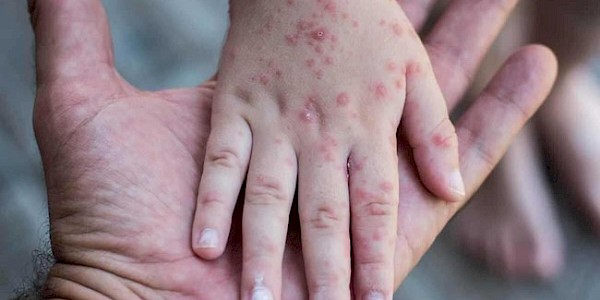 Kızamık Hastalığı nedir? Nasıl Bulaşır?