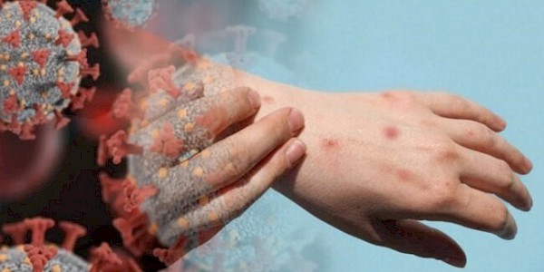 Maymun Çiçeği (Mpox) Hakkında Sıkça Sorulan Sorular
